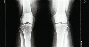 knee osteoarthritis Stocksy txpe438a7f1mfv300 Medium 1415006 Facebook