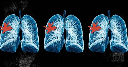 lungs scans 1200 628 facebook